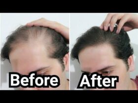 How to Grow Hair Faster for Men: Unlock Rapid Hair Growth for Men" Expert tips"