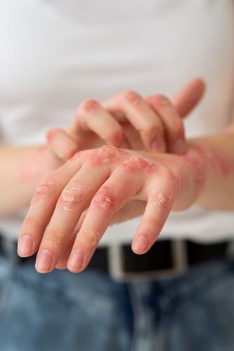 Eczema causes precautions and treatments